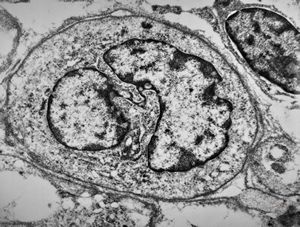 M,15y. | rhabdomyoma - lip M,15y. | rhabdomyoma - lip